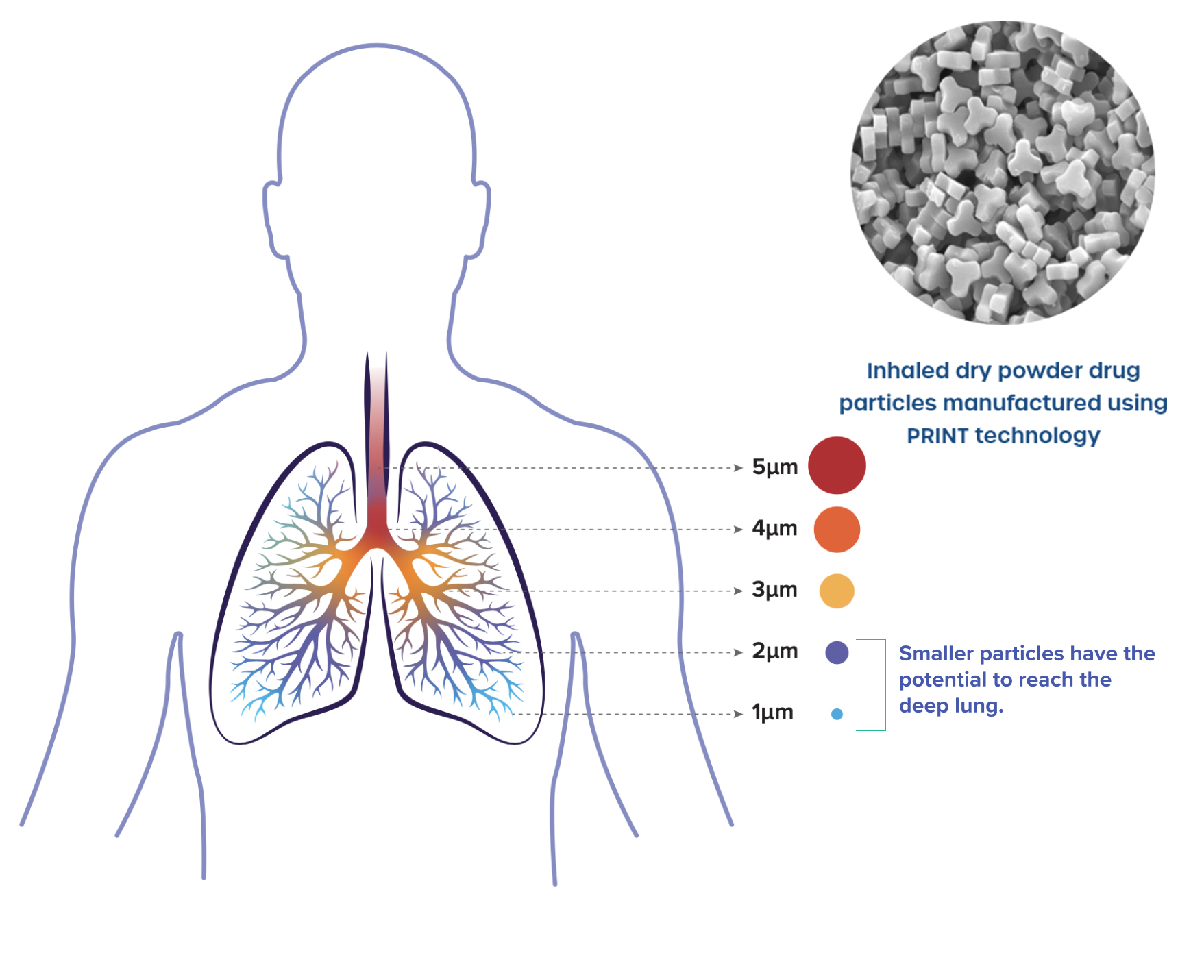 Diagram of human lungs with bronchi.  Colored dots represent inhaled dry powder particles ranging from 1 to 5 micrometers in size. Smaller particles (blue, 1-2µm) reach deeper into the lungs than larger particles (red, 5µm) which deposit higher in the airways. Inset image shows magnified view of dry powder particles.